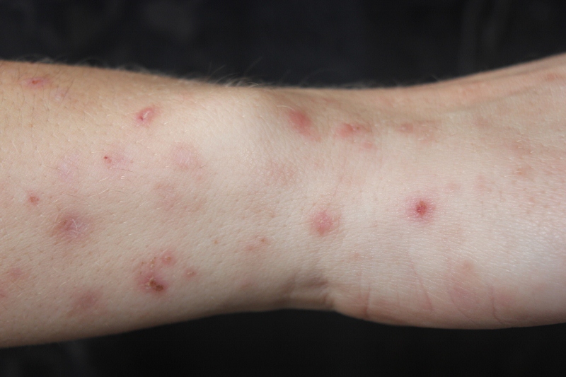 Bed bug bites treatment for skin 